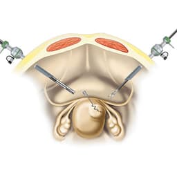 Endoscopic Myoma Screw with Detachable Myoma Drill-Product Picture Enlargement CW