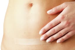 Scar Repair application-Scar Repair application caesarean 1